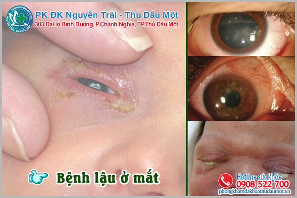 Hình ảnh bệnh lậu ở mắt