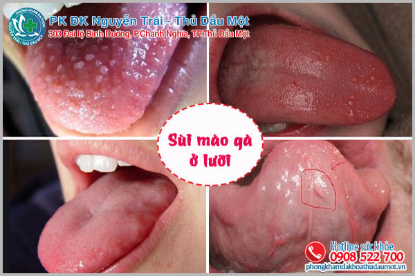 Sùi mào gà ở lưỡi